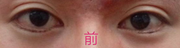 ”戒色前后的眼睛变化，无美颜对比。