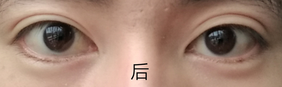 ”戒色前后的眼睛变化，无美颜对比。