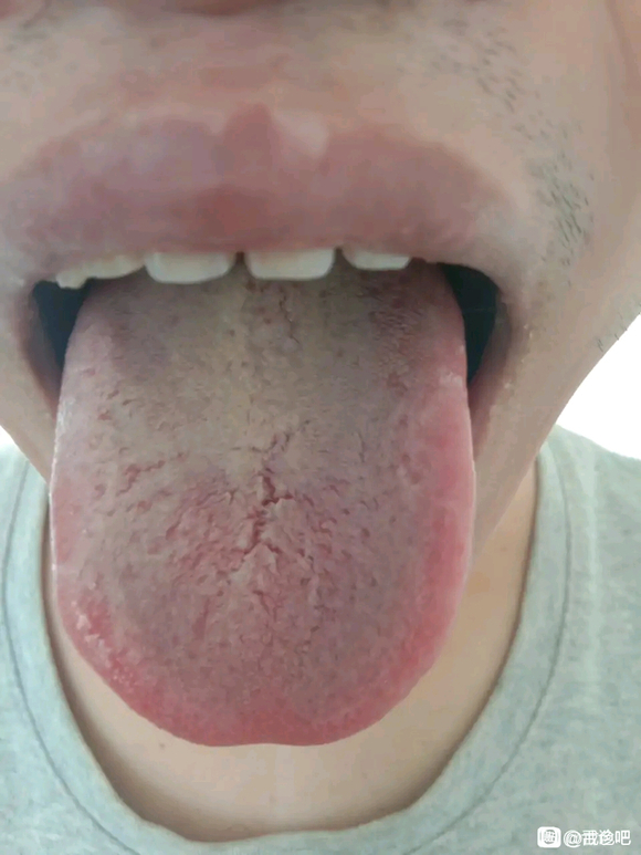 ”我好像真得静脉漏了！