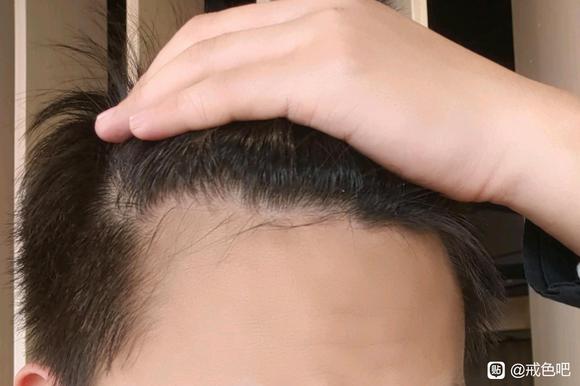 ”sy导致脱发大概要怎么样才能好