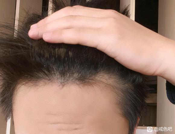 ”sy导致脱发大概要怎么样才能好