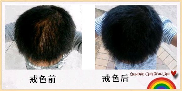 ”吧里的兄弟有做过植发的吗？效果有用吗