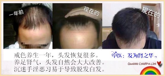 ”吧里的兄弟有做过植发的吗？效果有用吗