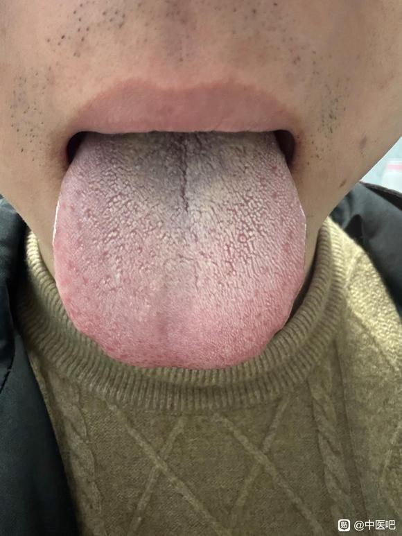 ”【发帖先看置顶】这个舌苔这么调理对吗
