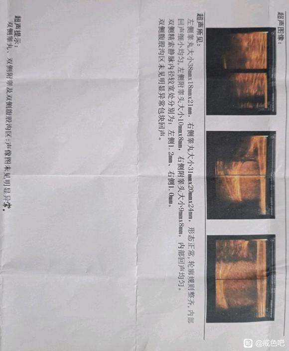 ”左边睾丸隐痛