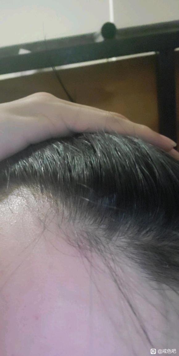 ”兄弟们你们戒后头发会长出来吗