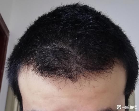 ”头发好像变得有点硬了，是肾气在恢复吗？