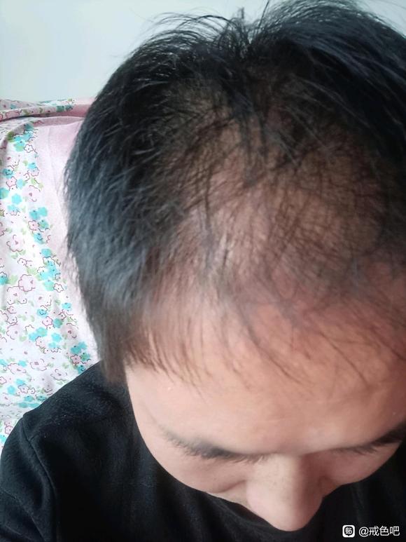 ”头发好像变得有点硬了，是肾气在恢复吗？