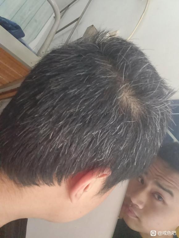 ”少年白还能恢复吗？