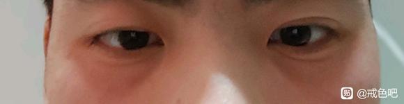 ”兄弟们眼窝凹陷怎么恢复啊，