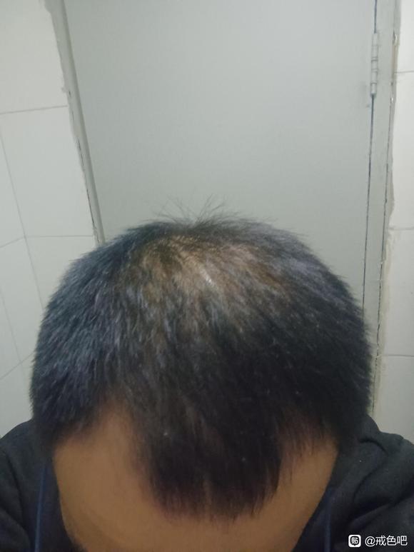 ”我这头发还有恢复可能吗