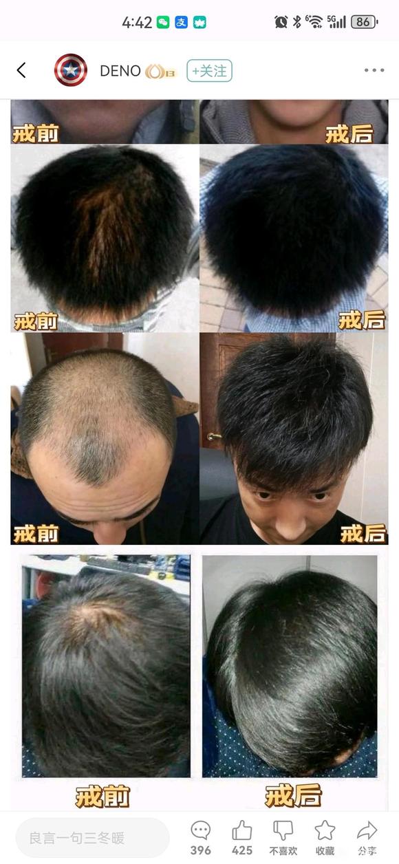 ”有发量恢复的真实案例吗