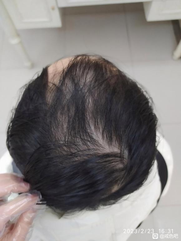 ”兄弟们赶快戒吧，撸了14年脱发严重去植发了