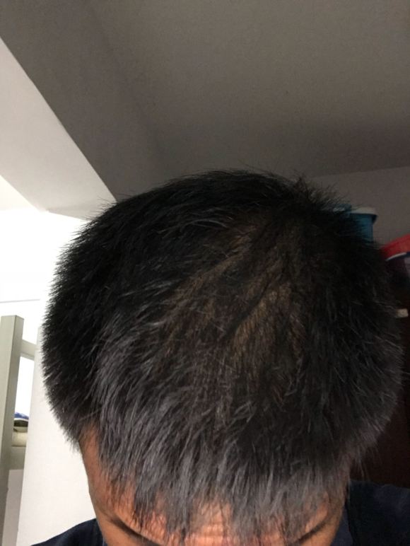 ”sy后的造成的脂溢性脱发