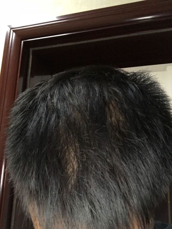 ”sy后的造成的脂溢性脱发