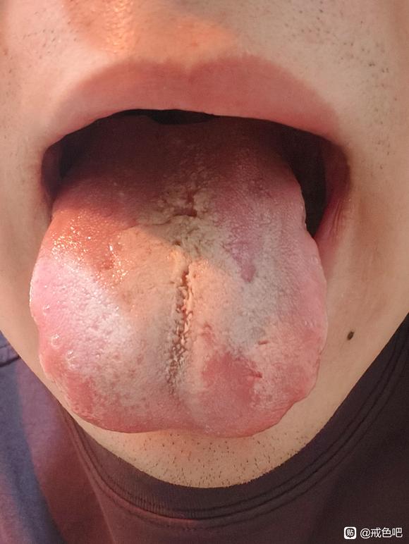 ”舌头中间有裂痕禁欲可以恢复吗？