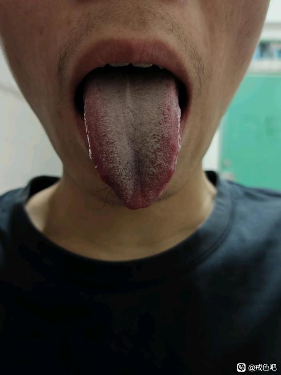 ”肾虚失眠男科前列腺炎精索静脉曲张