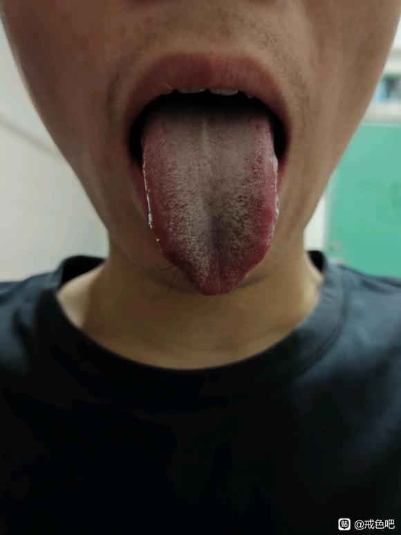 ”肾虚失眠男科前列腺炎精索静脉曲张