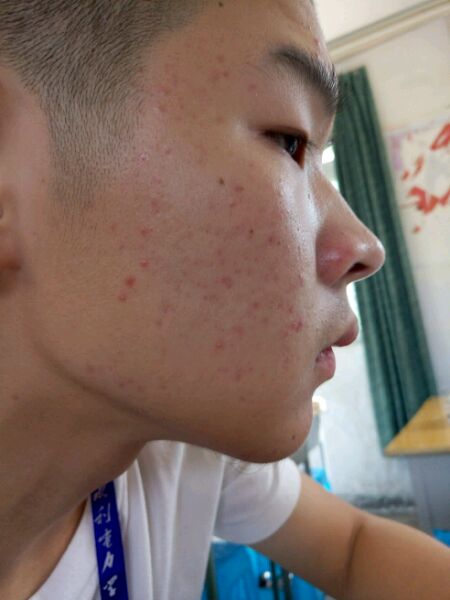 ”【成长记录】记录脸部气色等改善