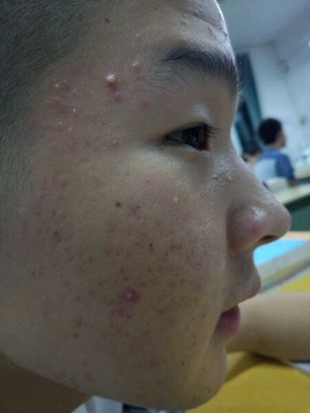 ”【成长记录】记录脸部气色等改善