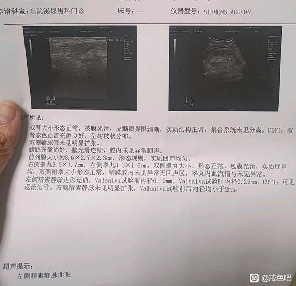 ”今天去检查了，左侧精索静脉曲张