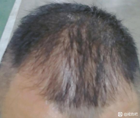 ”怎么才能长出头发