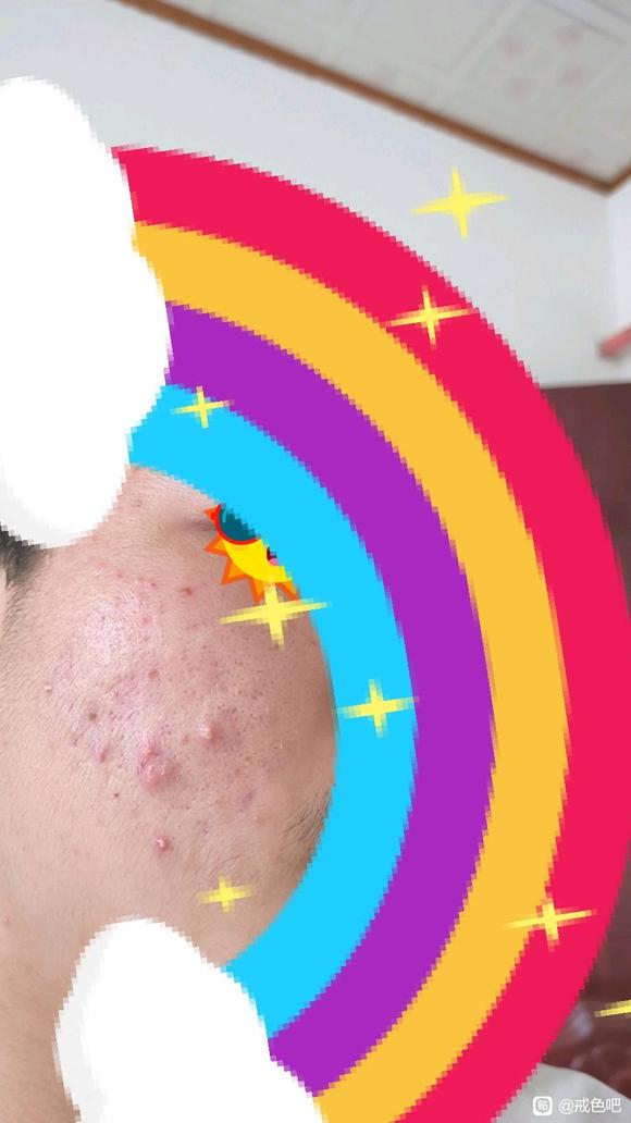 ”吧友们，这是不是内分泌失调引起的