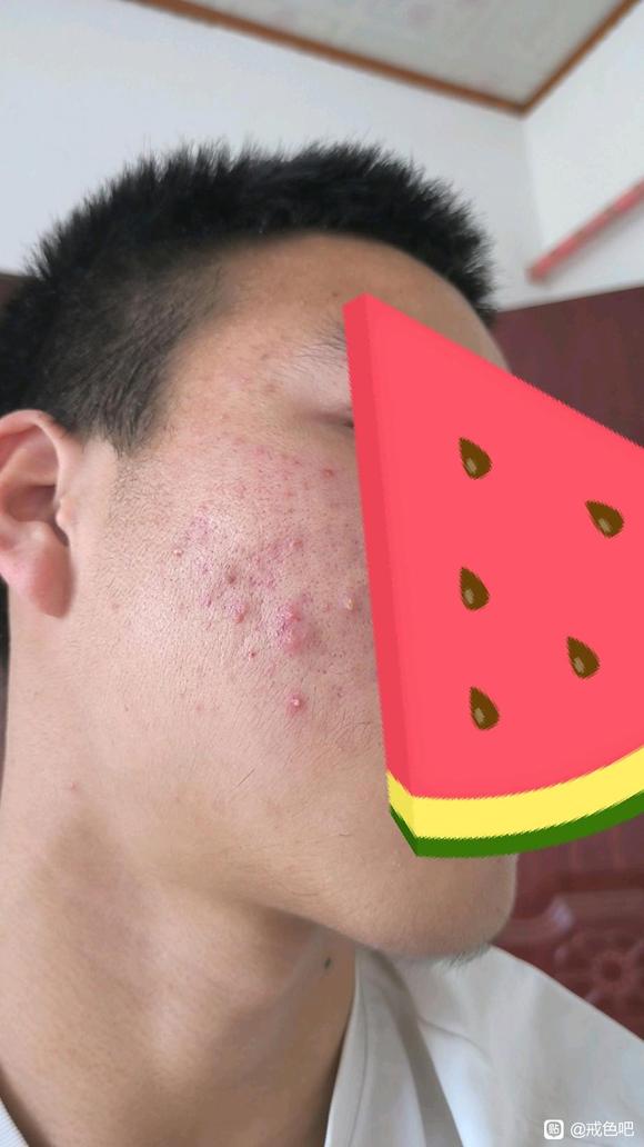 ”吧友们，这是不是内分泌失调引起的