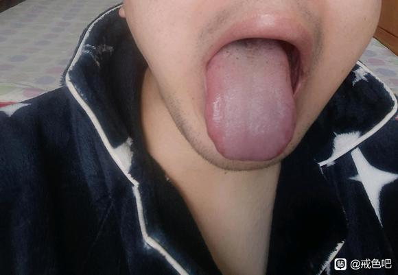 ”脾虚湿热下注