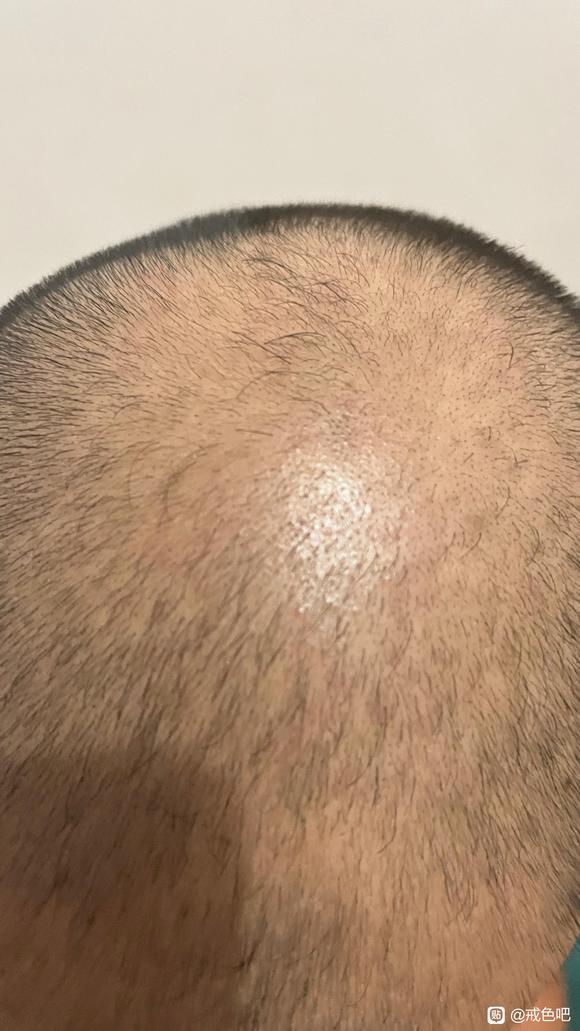 ”手淫这么多年的差别，前后对比照片，