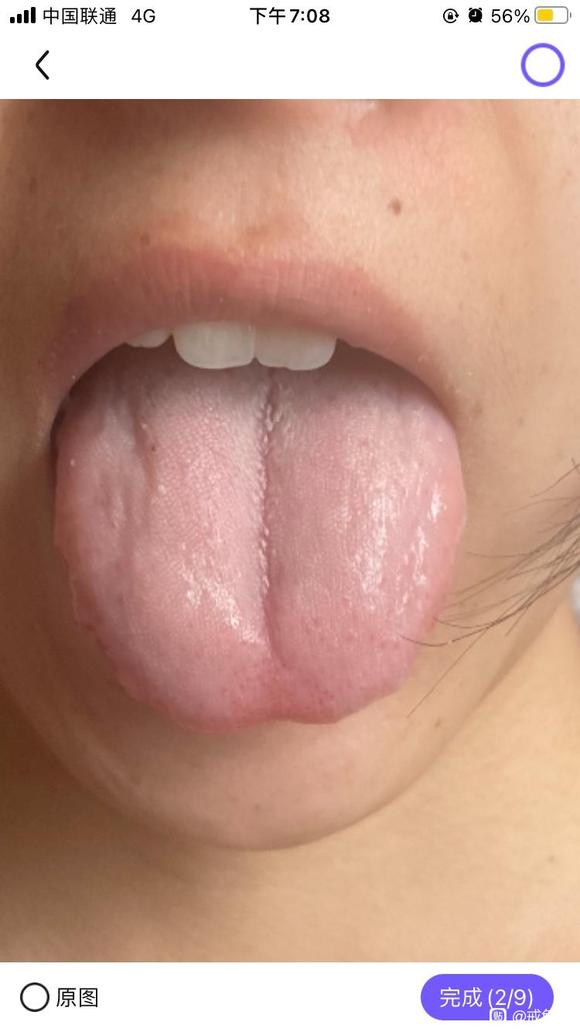 ”寒热错杂，不消化，目前打卡一个月了