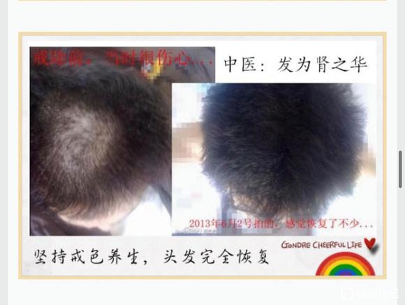 ”前辈有没有戒了之后头发恢复乌黑亮丽的案例