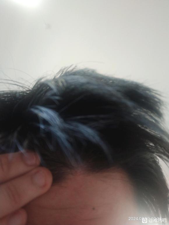 ”脱发还能再长回来吗