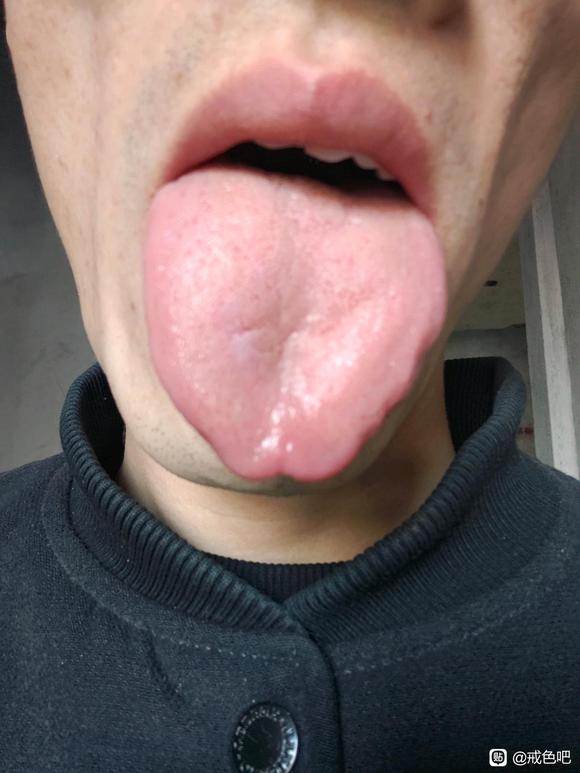 ”这个舌苔是什么病