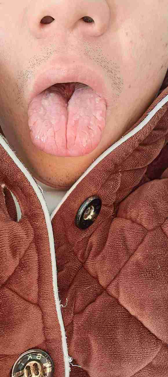 ”sy20年，要不要吃药物啥的，腰疼