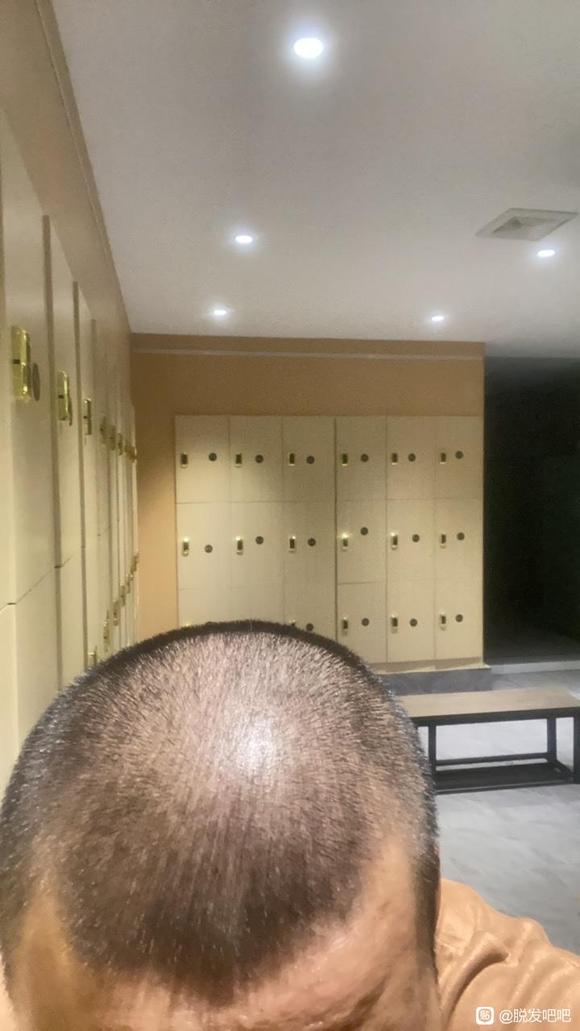 ”努力戒色想要恢复以前的头发，心累啊