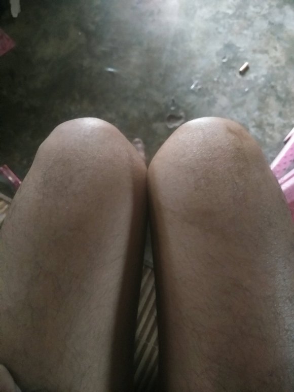 ”手淫后，去打球膝盖扭伤走路都走不了，伸都伸不直，一伸就痛，你