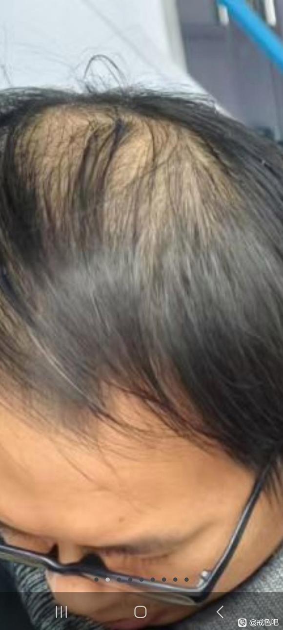 ”哎，秃顶还没有恢复