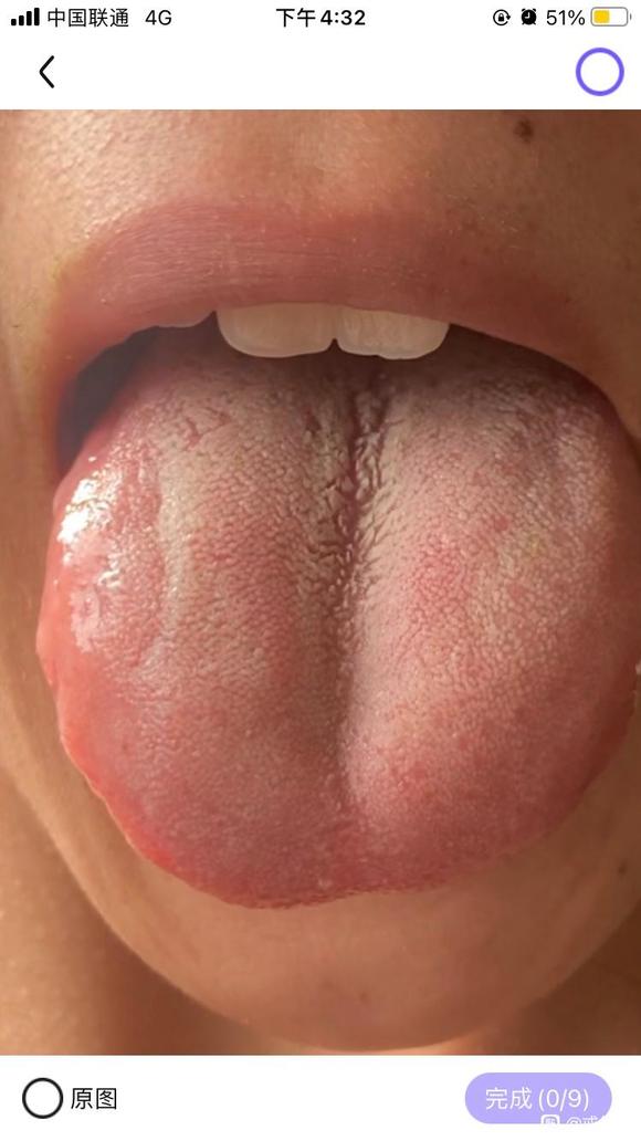 ”有无裂纹舌，重度脾虚恢复的，没这情况的不要评论