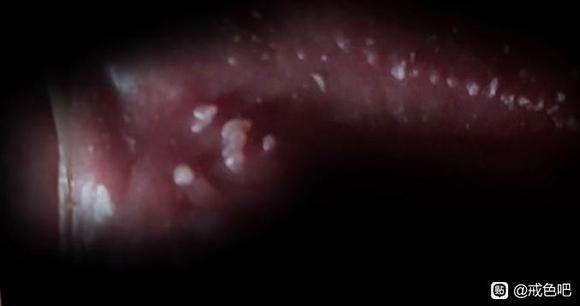 ”警告！手淫会导致龟