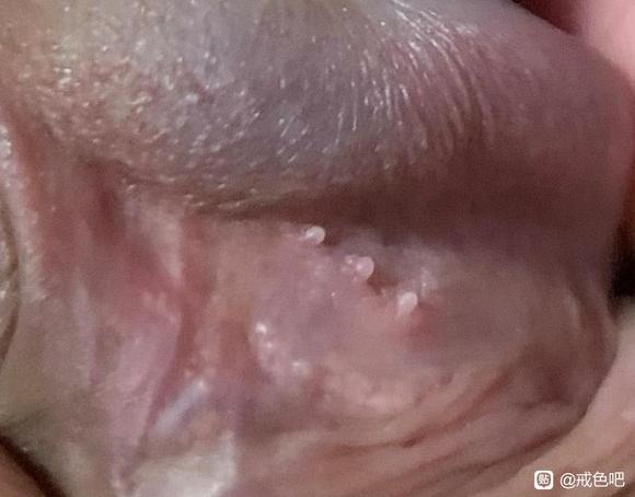 ”警告！手淫会导致龟