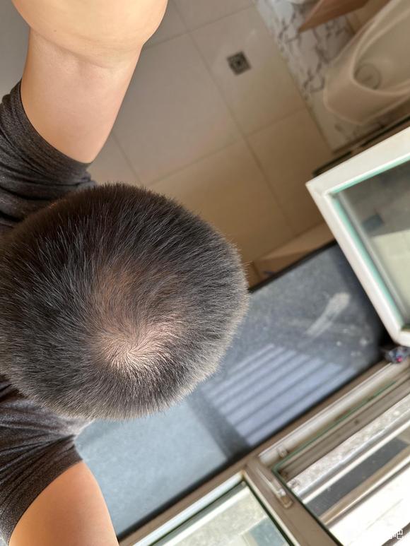 ”帮忙看下这种脱发程度要多久才能恢复呀