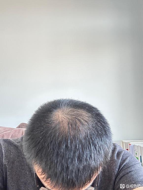 ”帮忙看下这种脱发程度要多久才能恢复呀