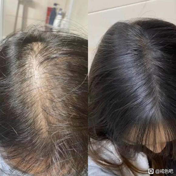”帮忙看下这种脱发程度要多久才能恢复呀