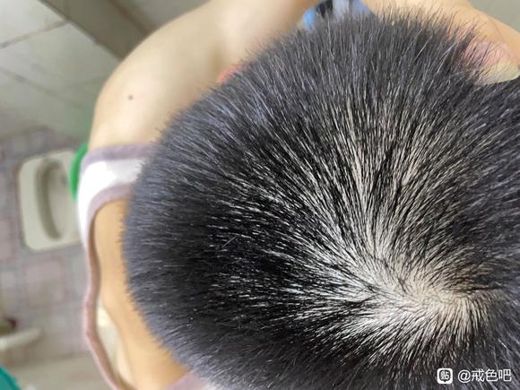 ”邪淫导致的脱发恶报