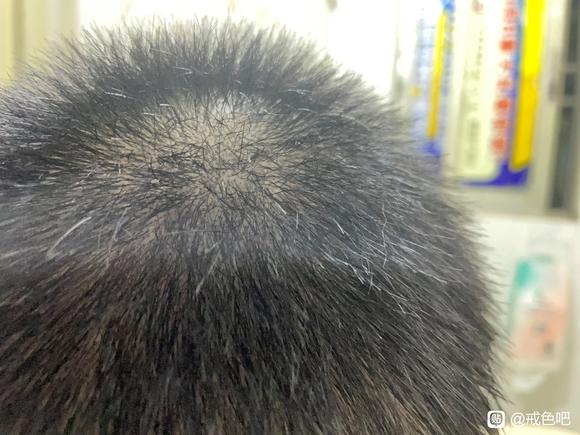 ”邪淫导致的脱发恶报