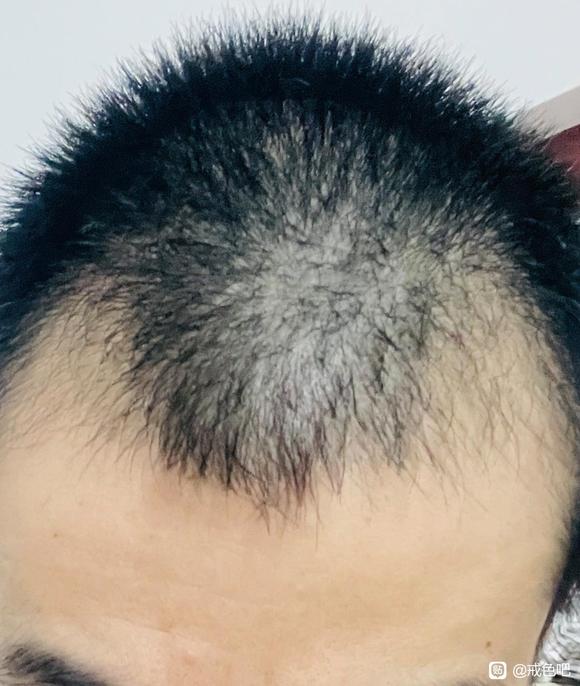 ”邪淫导致的脱发恶报