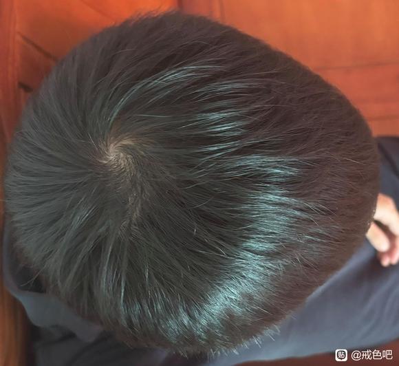 ”脂溢性皮炎脱发