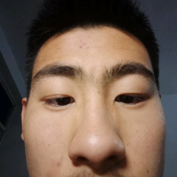 ”眼睛凹陷什么时候能好?