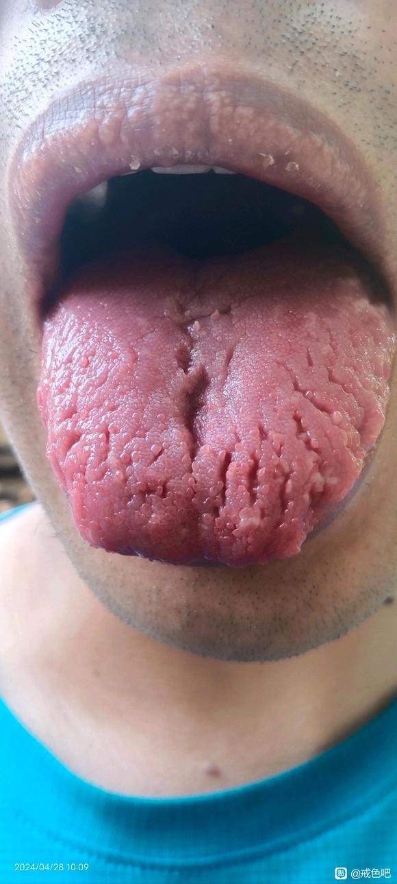 ”舌头开裂十六年，谁能救救我呀